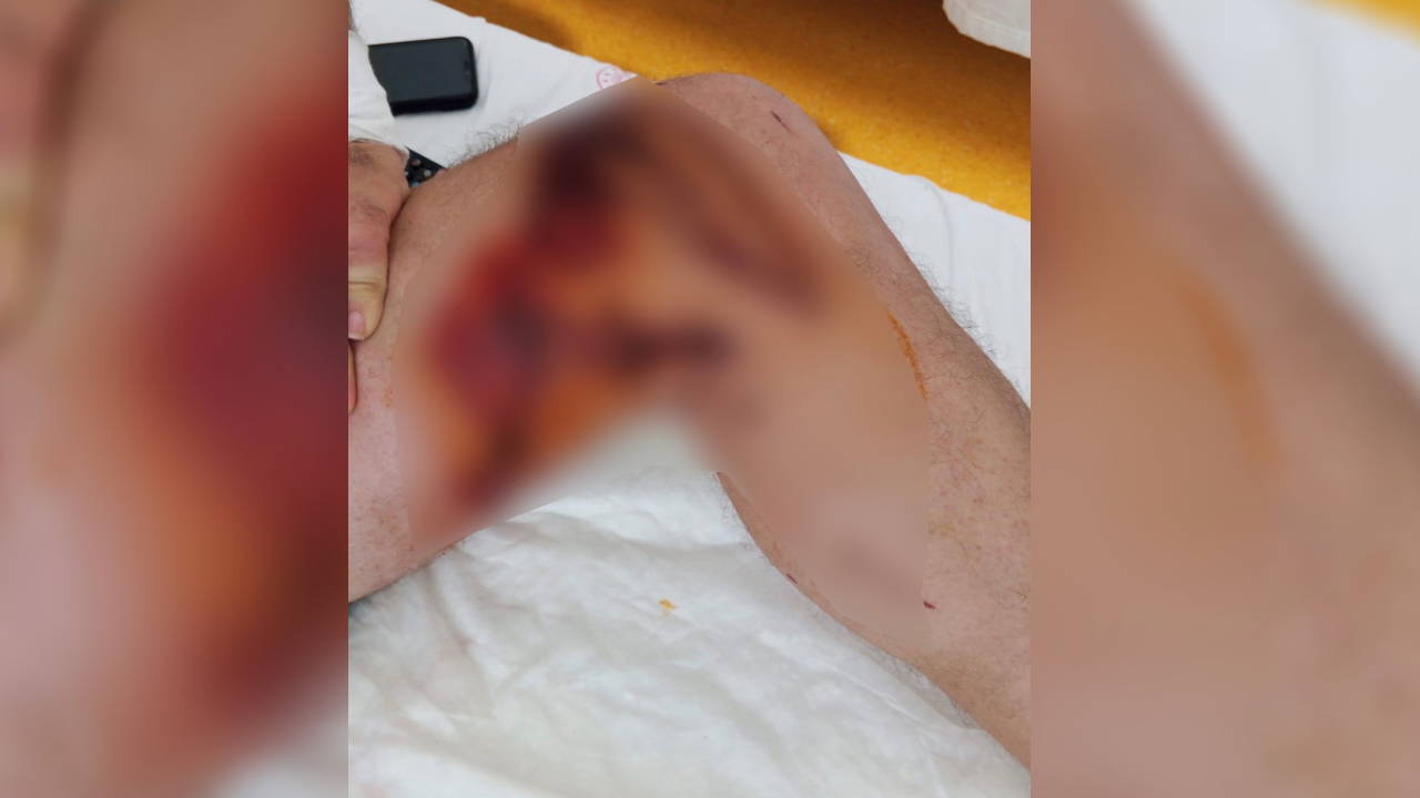 Lavabo açıcı aracının içinde üzerinde döküldü: Vücudunun yüzde 15’i yandı